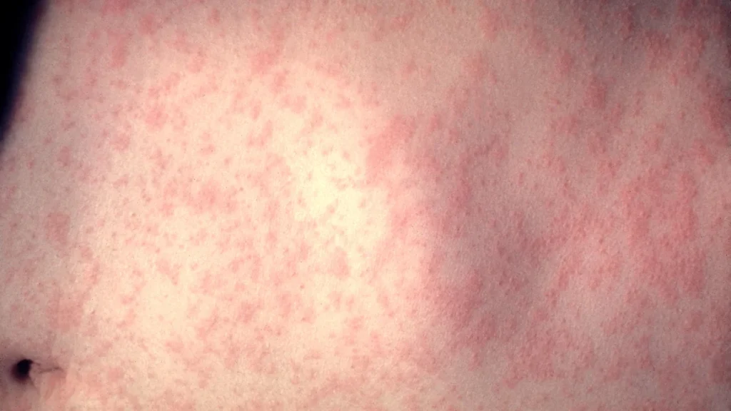 A red rash is one hallmark of a measles infection.